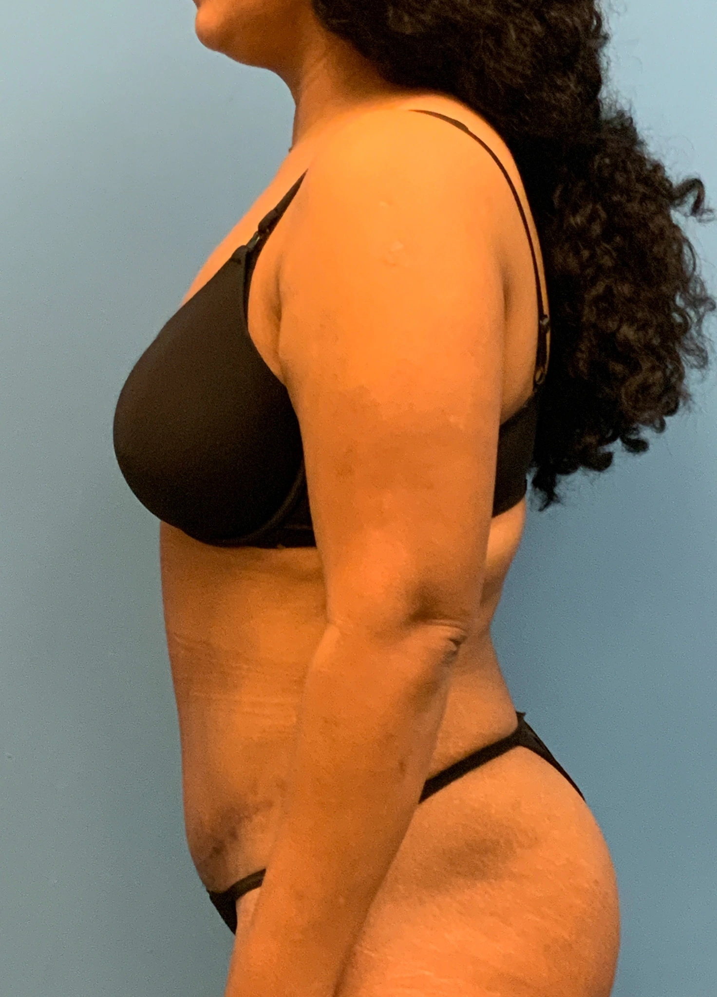Abdominoplasty-Case--1110 | After Tummy Tuck 3