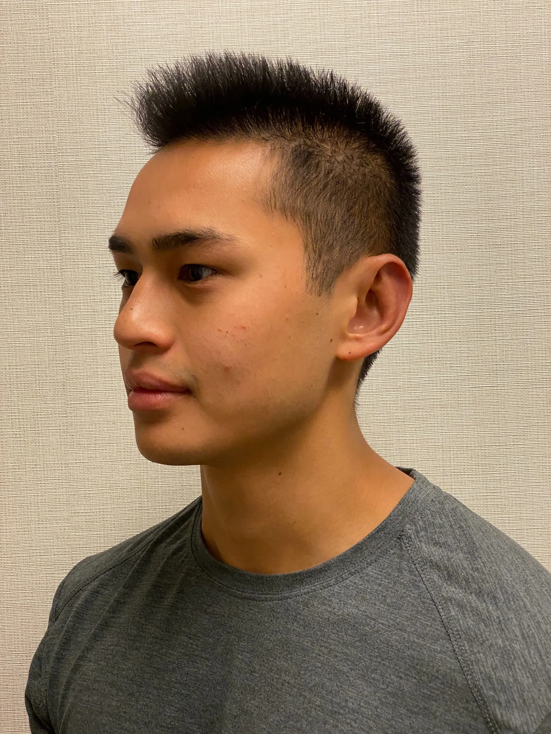 Otoplasty-Case--2681 | After Otoplasty 4