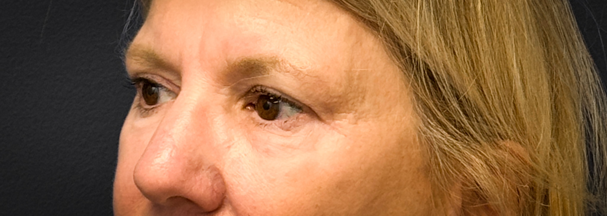 Blepharoplasty-Case--2653 | After Dr. Frank Albino 2