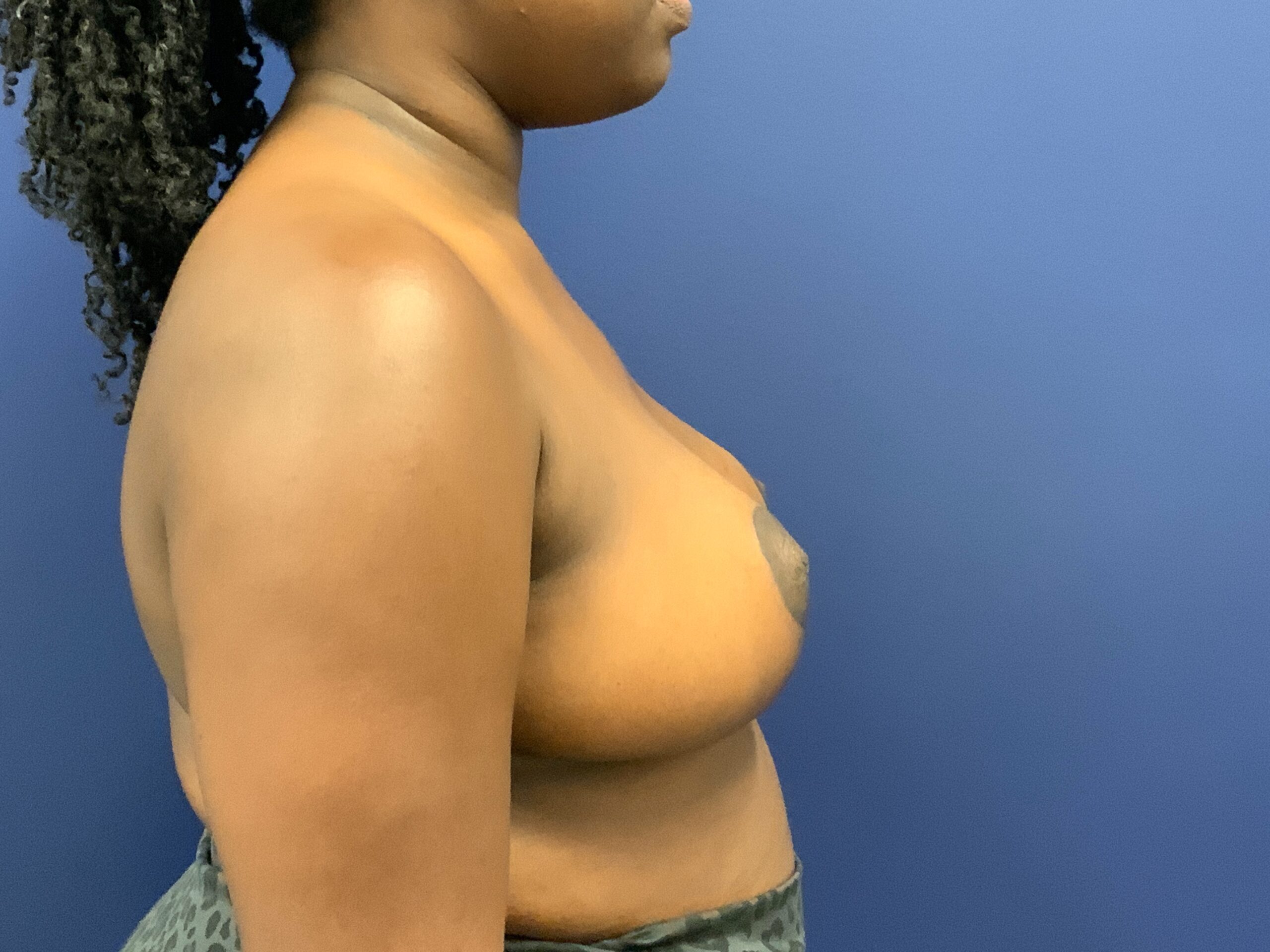 Breast-Reduction-Case--7783 | After Dr. Arjun Kanuri 2