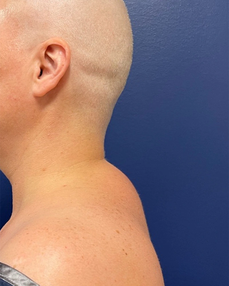 Submental-Liposuction-Case--9534 | Before Submental Liposuction 1
