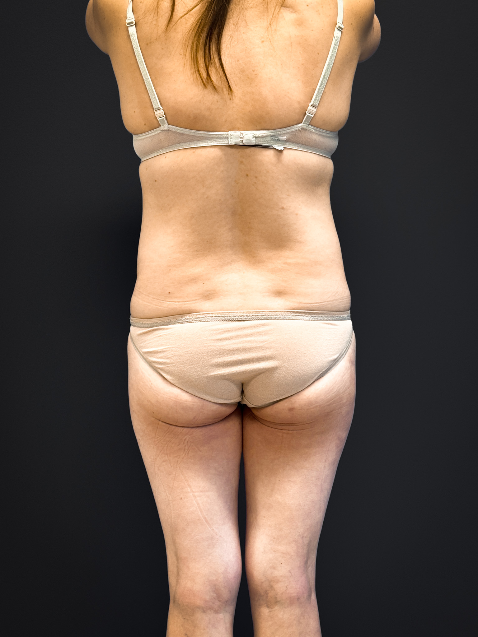 Tummy-Tuck-Case--5969 | Before Tummy Tuck 6