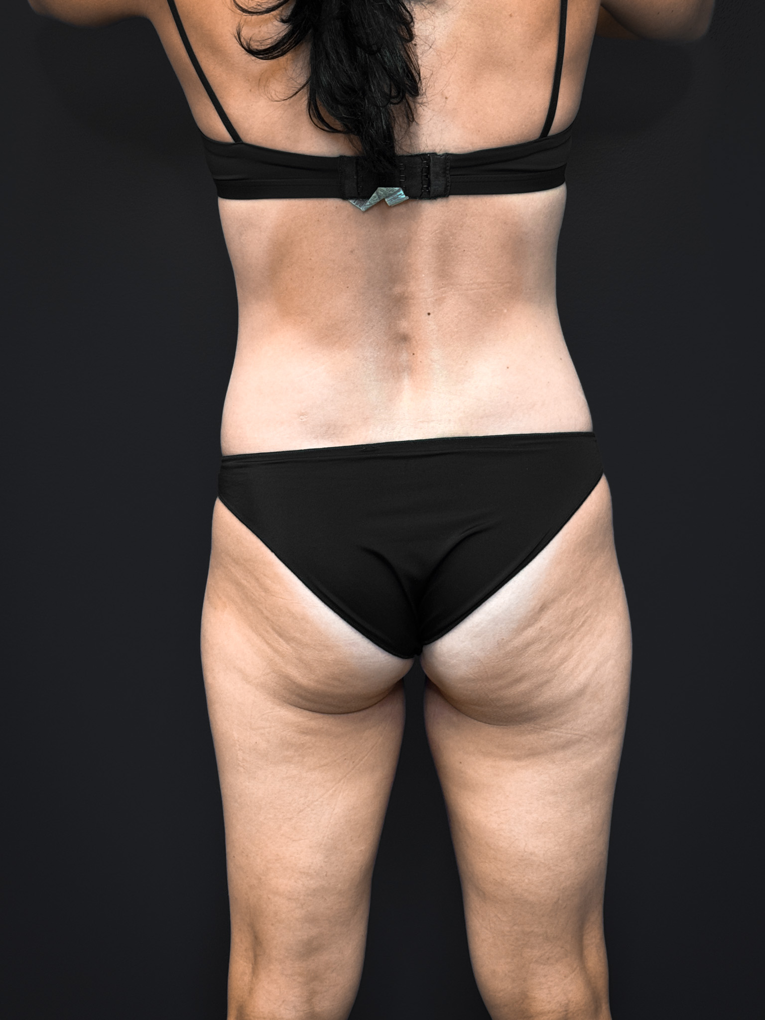 Tummy-Tuck-Case--2729 | Before Tummy Tuck 6