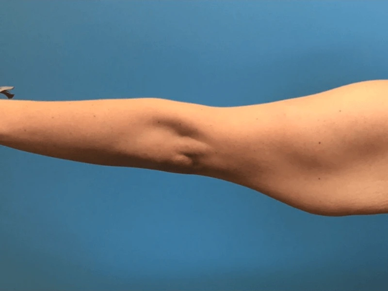 Brachioplasty-Case--276 | Before Arm Lift 1