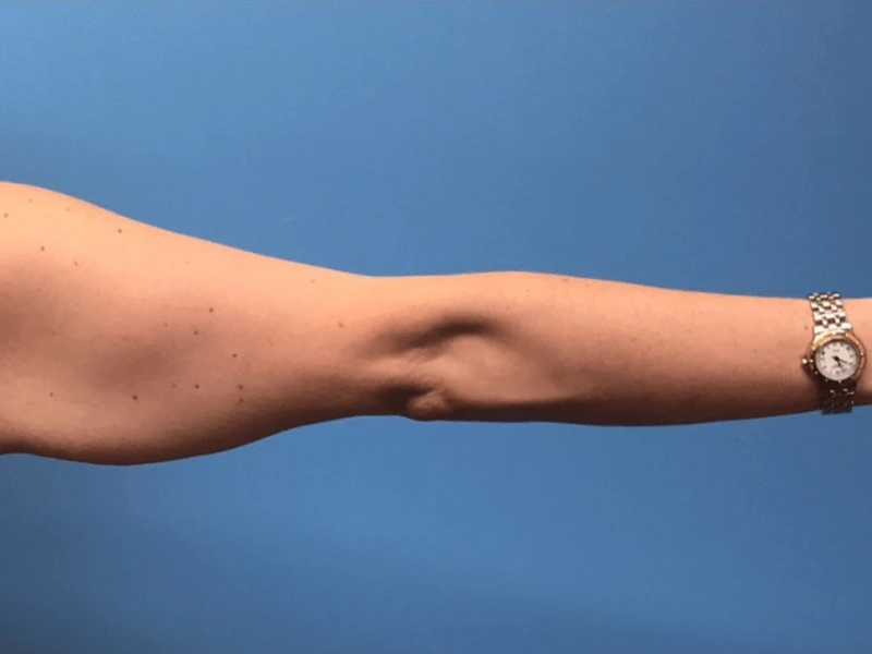 Brachioplasty-Case--276 | Before Arm Lift 2