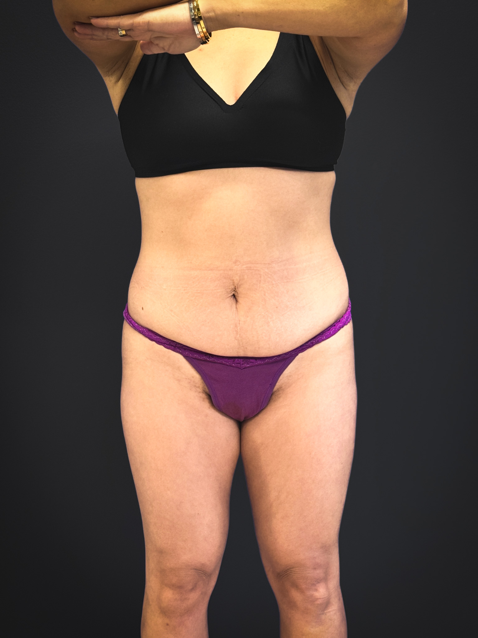 Tummy-Tuck-Case--3757 | Before Body 1