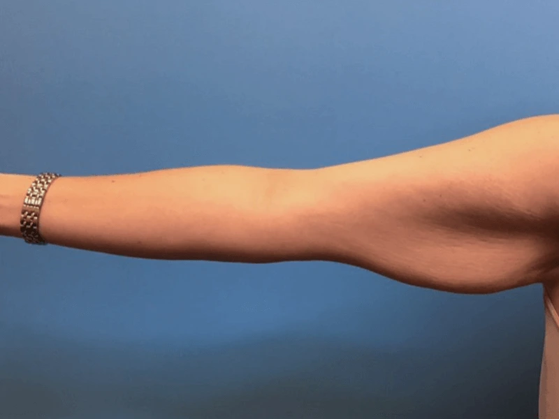Brachioplasty-Case--276 | Before Arm Lift 3