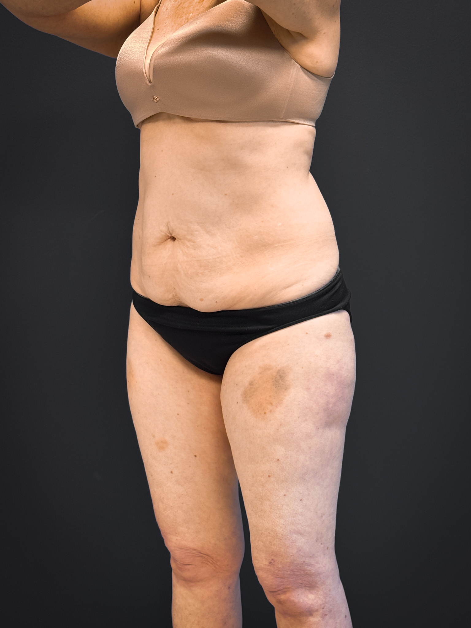Tummy-Tuck-Case--7170 | Before Body 2