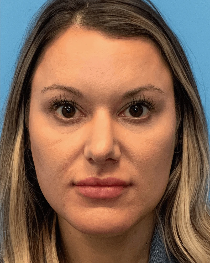 Rhinoplasty-Case--23703 | Before Rhinoplasty 1
