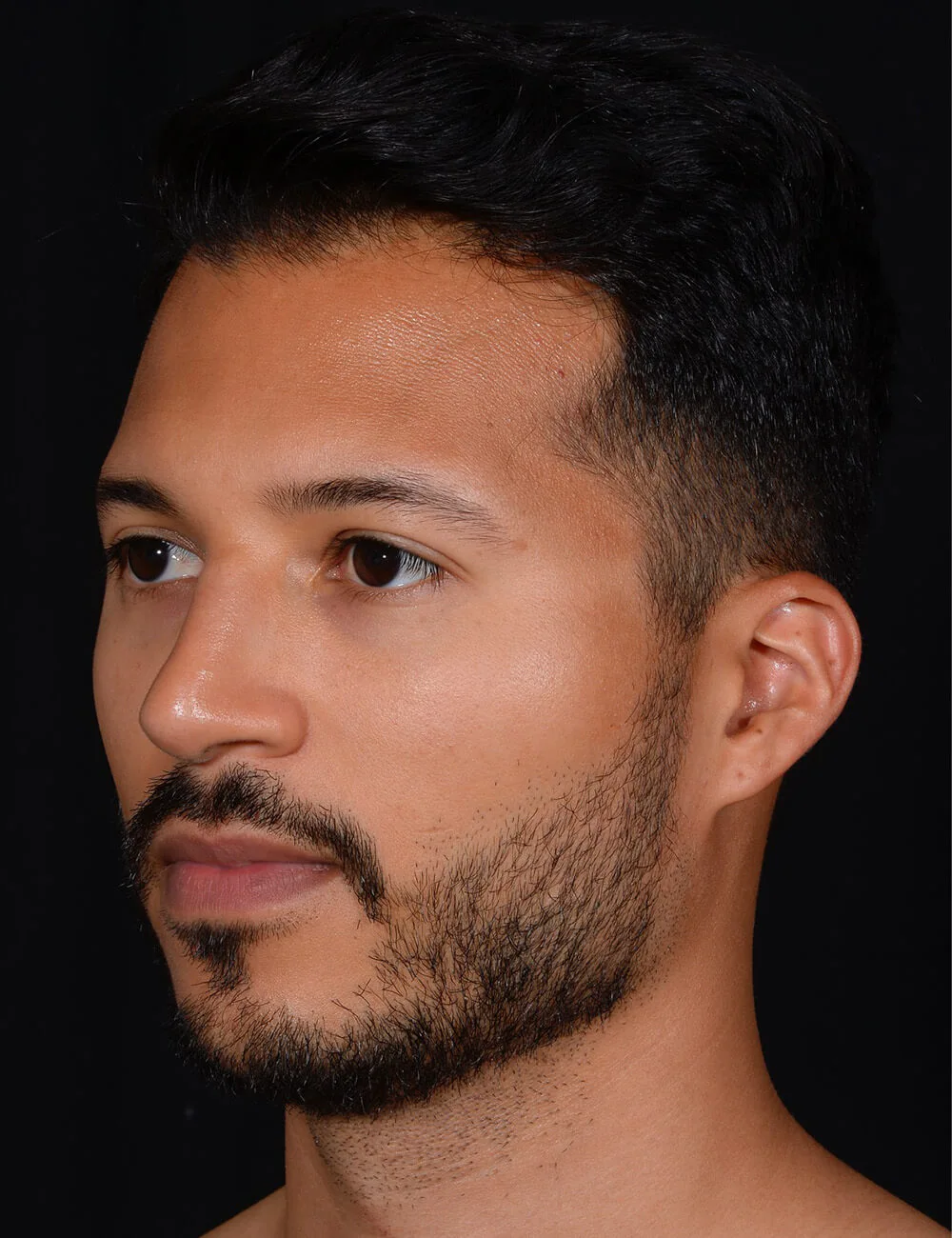 Rhinoplasty-Case--379 | Before Rhinoplasty for Men 3