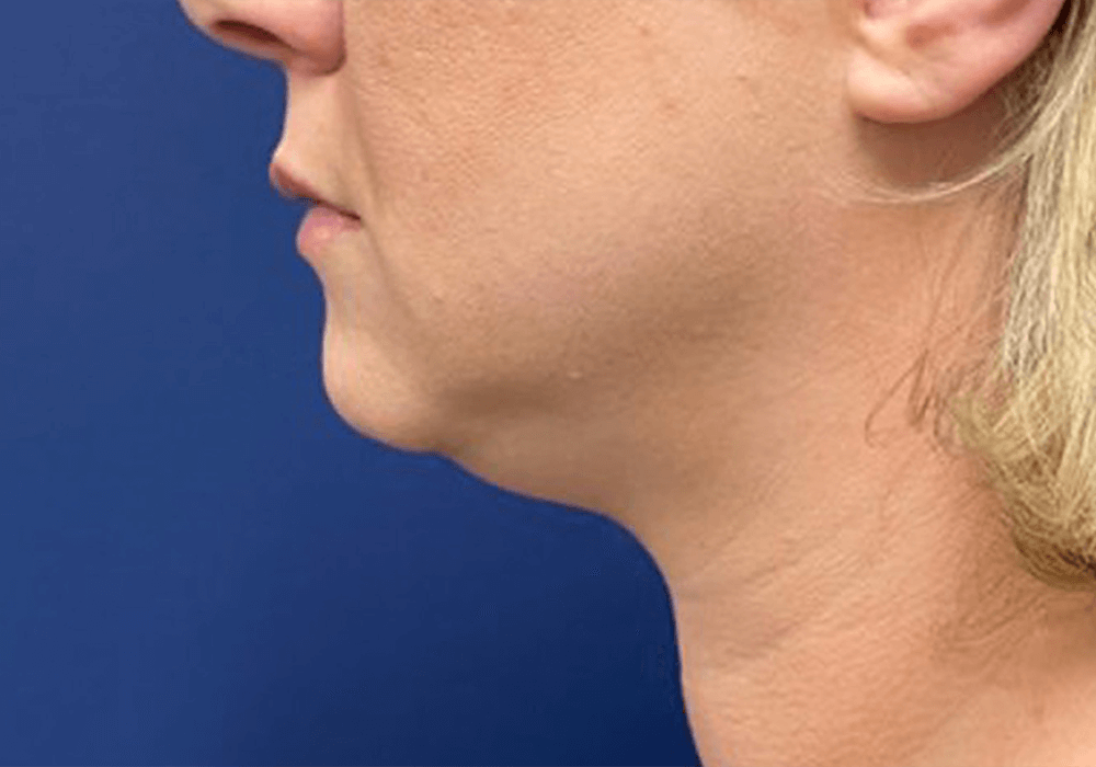 Submental-Liposuction-Case--20811 | Before Submental Liposuction 1