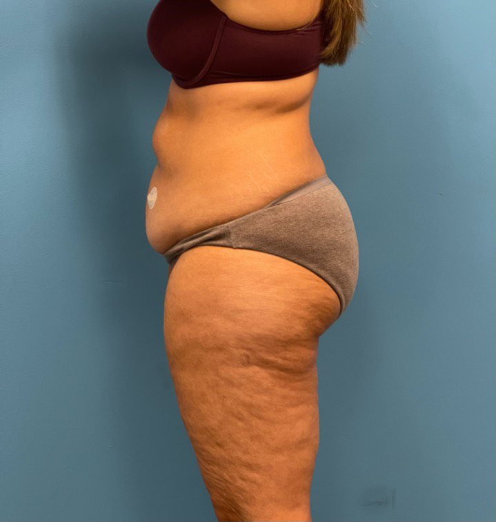 Lipoabdominoplasty-Case--25555 | Before Body 2