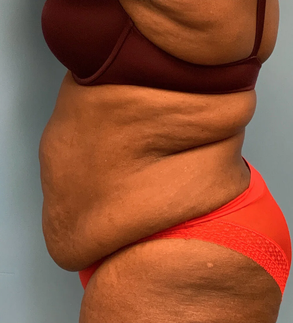Lipoabdominoplasty-Case--24124 | Before Tummy Tuck 3