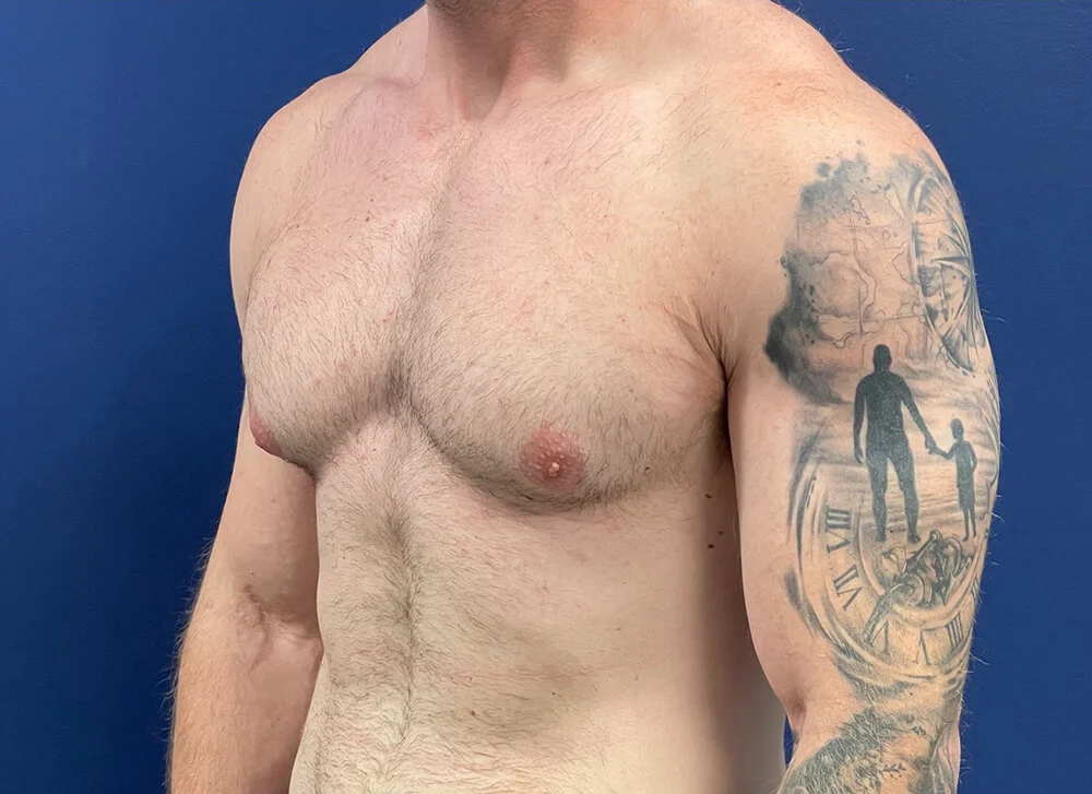 Gynecomastia-Case--28230 | Before Gynecomastia / Male Breast Reduction 2
