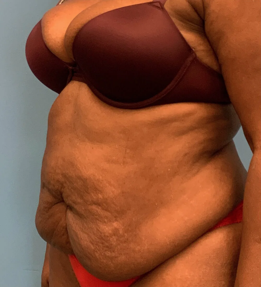 Lipoabdominoplasty-Case--24124 | Before Tummy Tuck 4