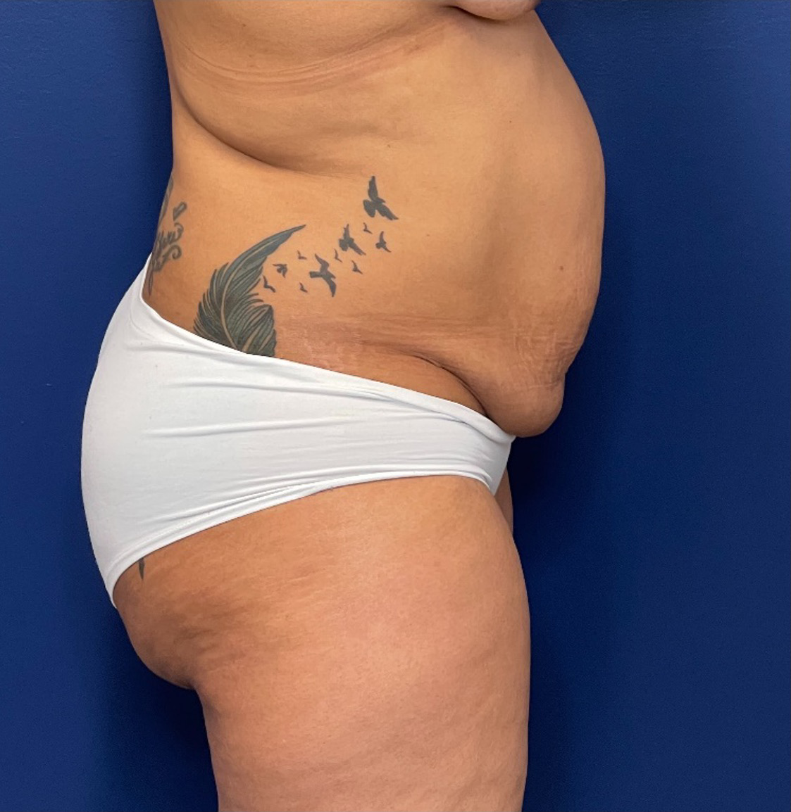 Liposuction-Case--254 | Before Body 2