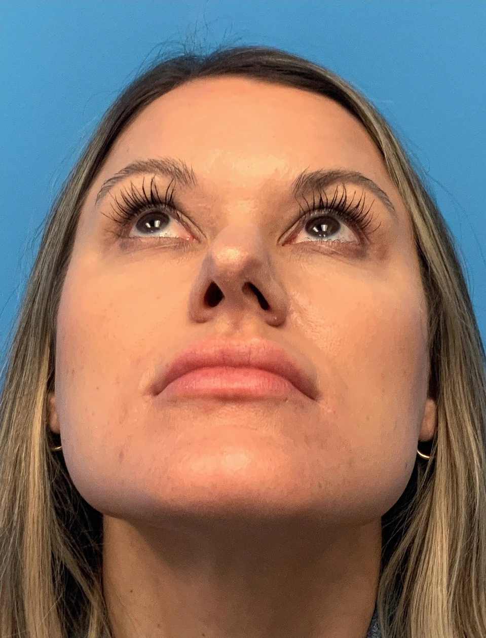 Rhinoplasty-Case--4972 | Before Rhinoplasty 2