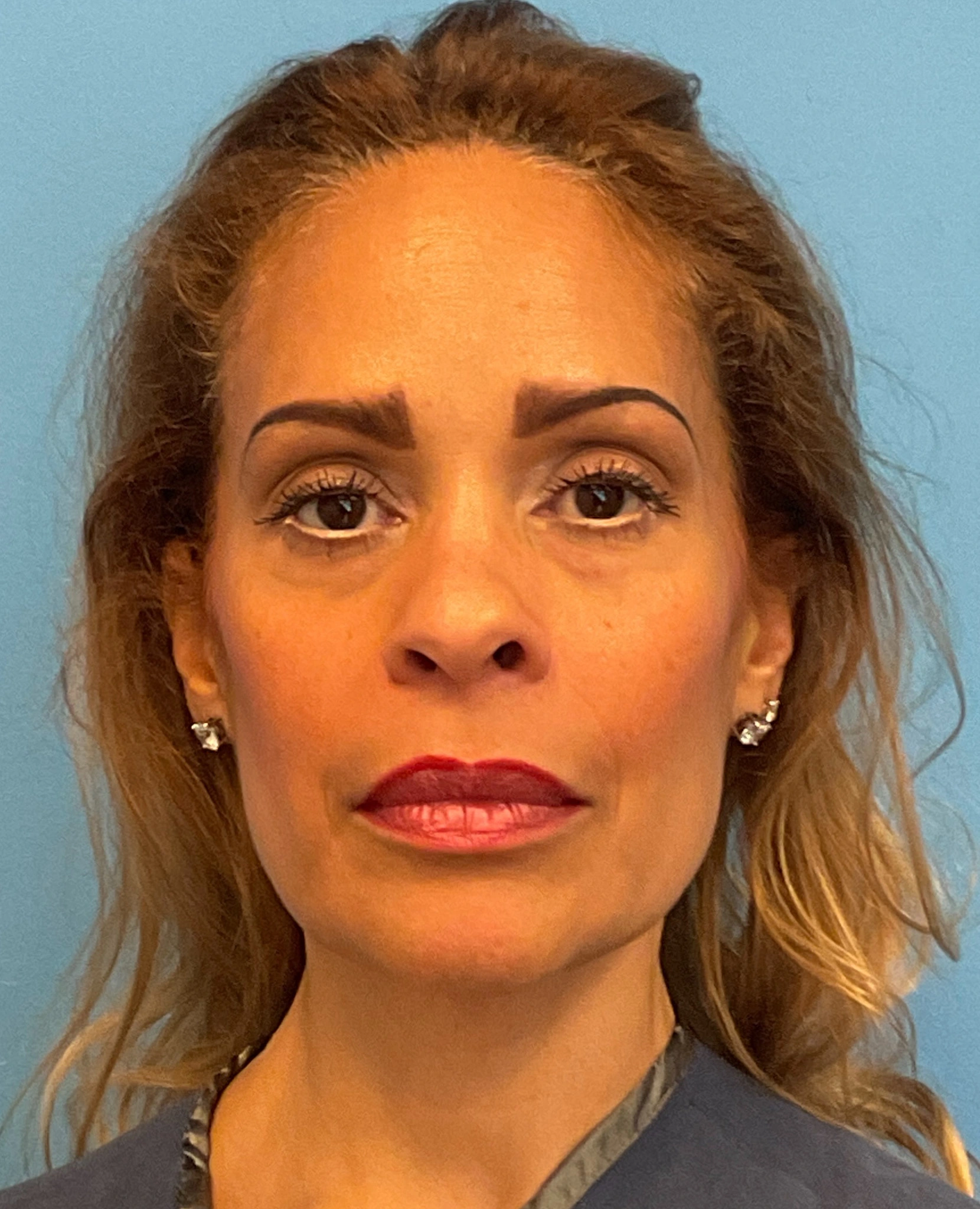 Facelift-and-Facial-Fat-Grafting-Case--4152 | Before Facelift 1