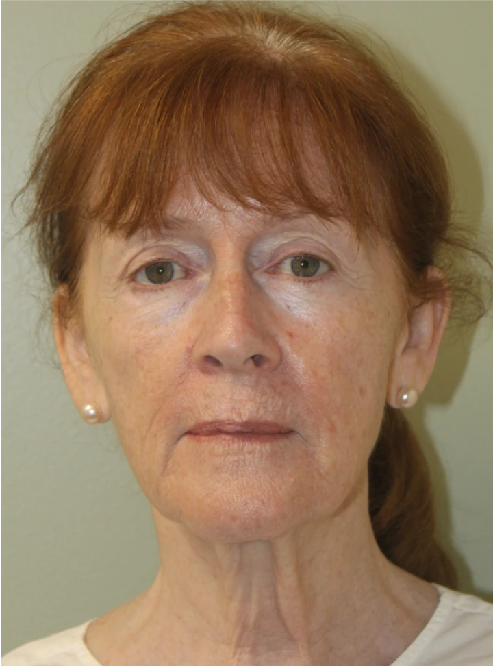 Necklift-Case--5698 | Before Neck Lift 1