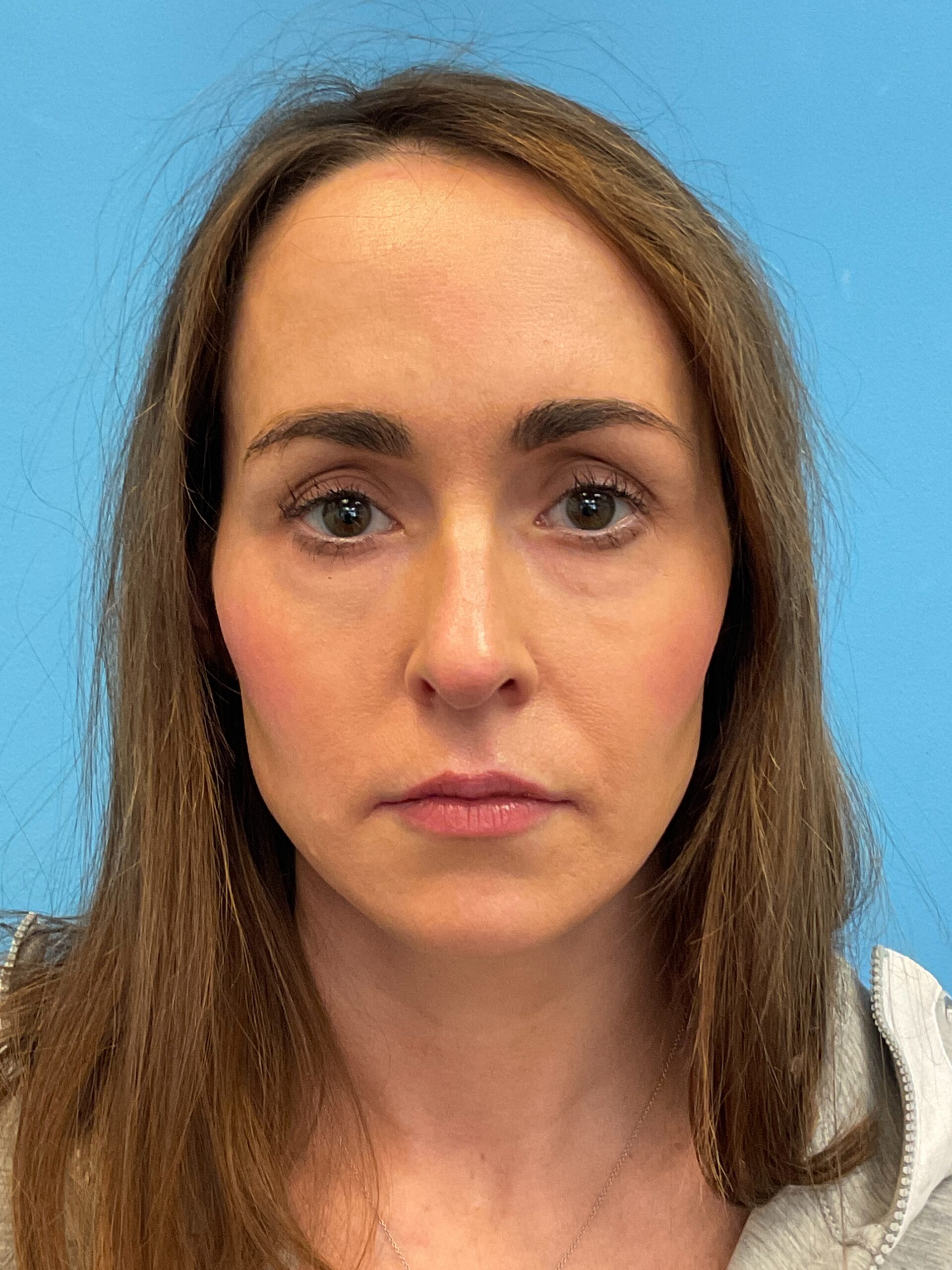Rhinoplasty-Case--1281 | Before Dr. Arjun Kanuri 1