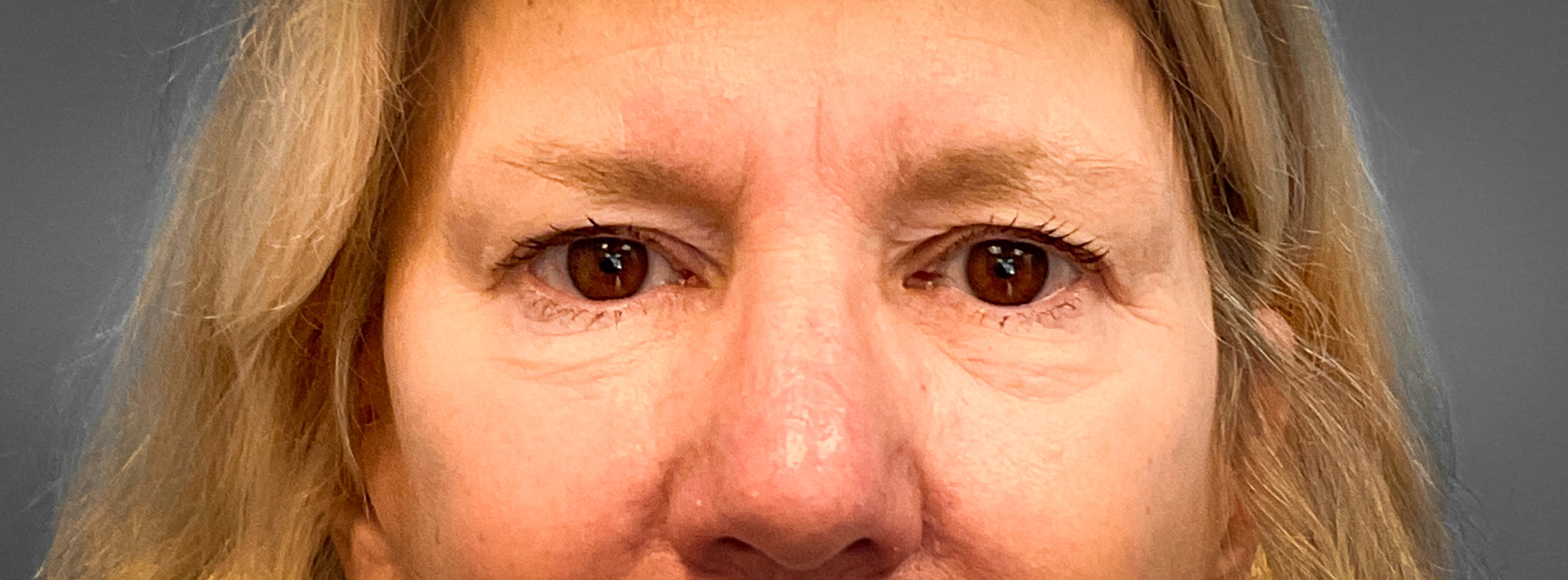 Blepharoplasty-Case--2653 | Before Dr. Frank Albino 1