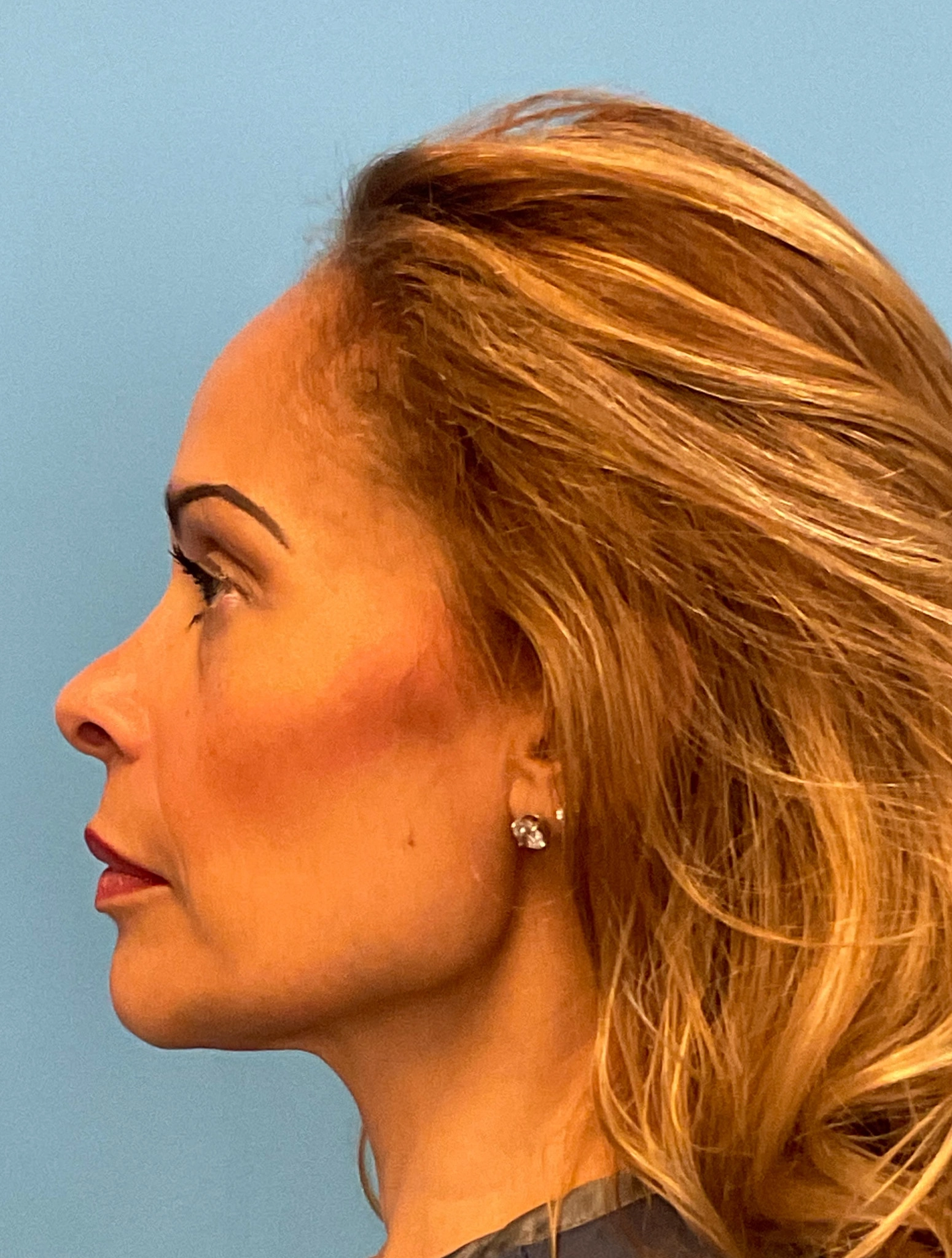 Facelift-and-Facial-Fat-Grafting-Case--4152 | Before Facelift 3
