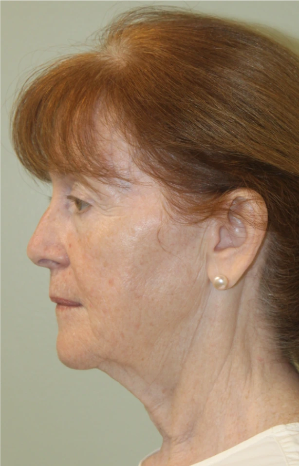 Necklift-Case--5698 | Before Neck Lift 2