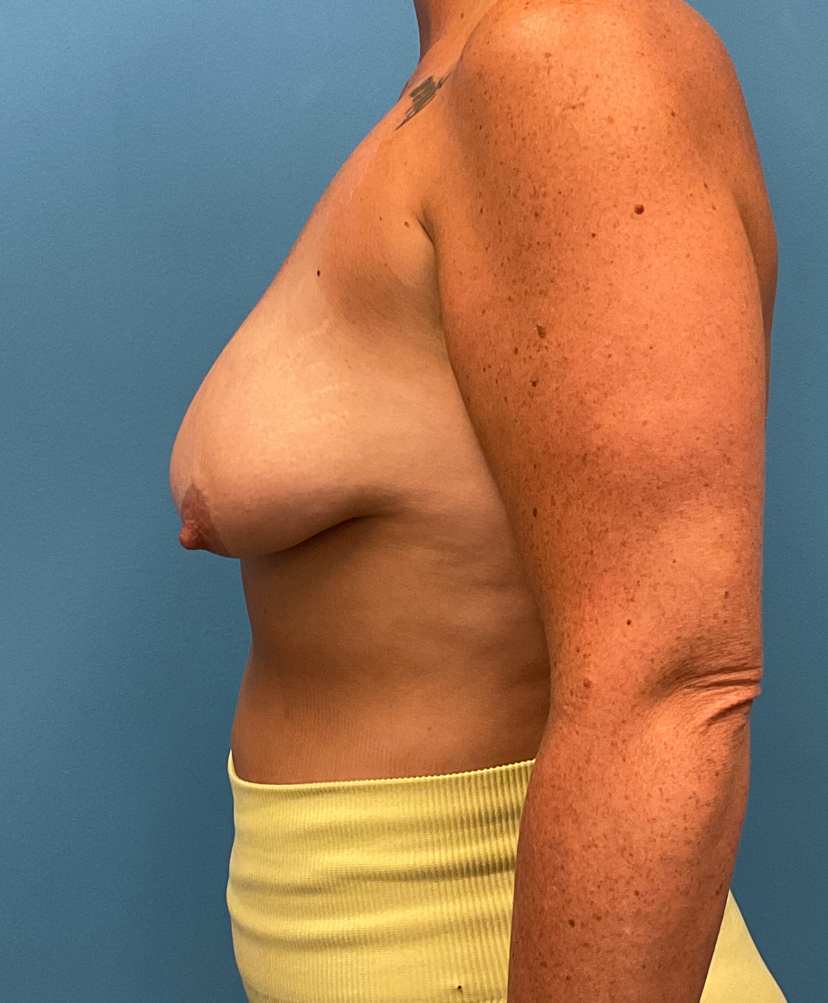 Augmentation-Mastopexy-Case--6355 | Before Breast Augmentation With Lift 3