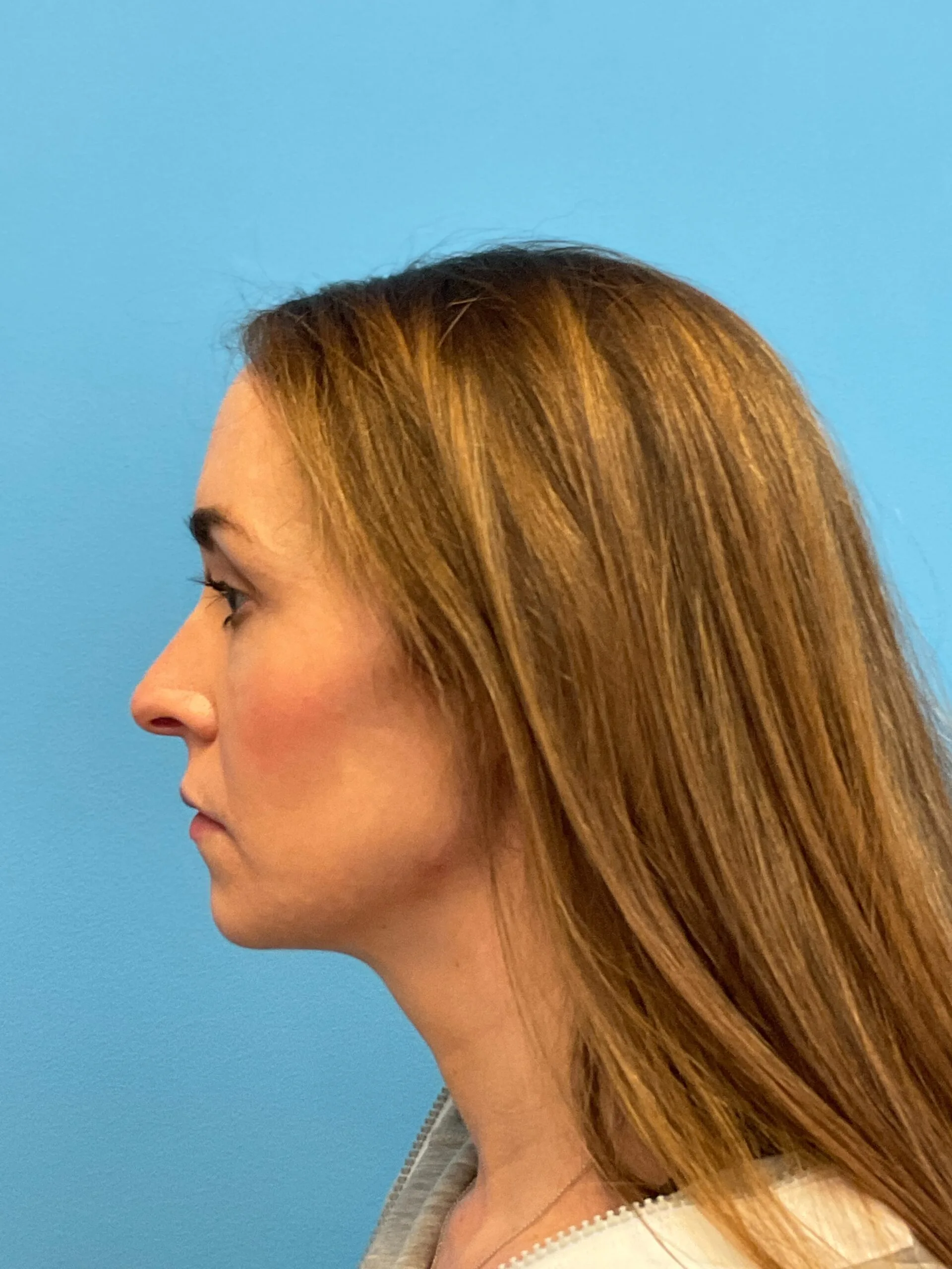Rhinoplasty-Case--1281 | Before Rhinoplasty 3