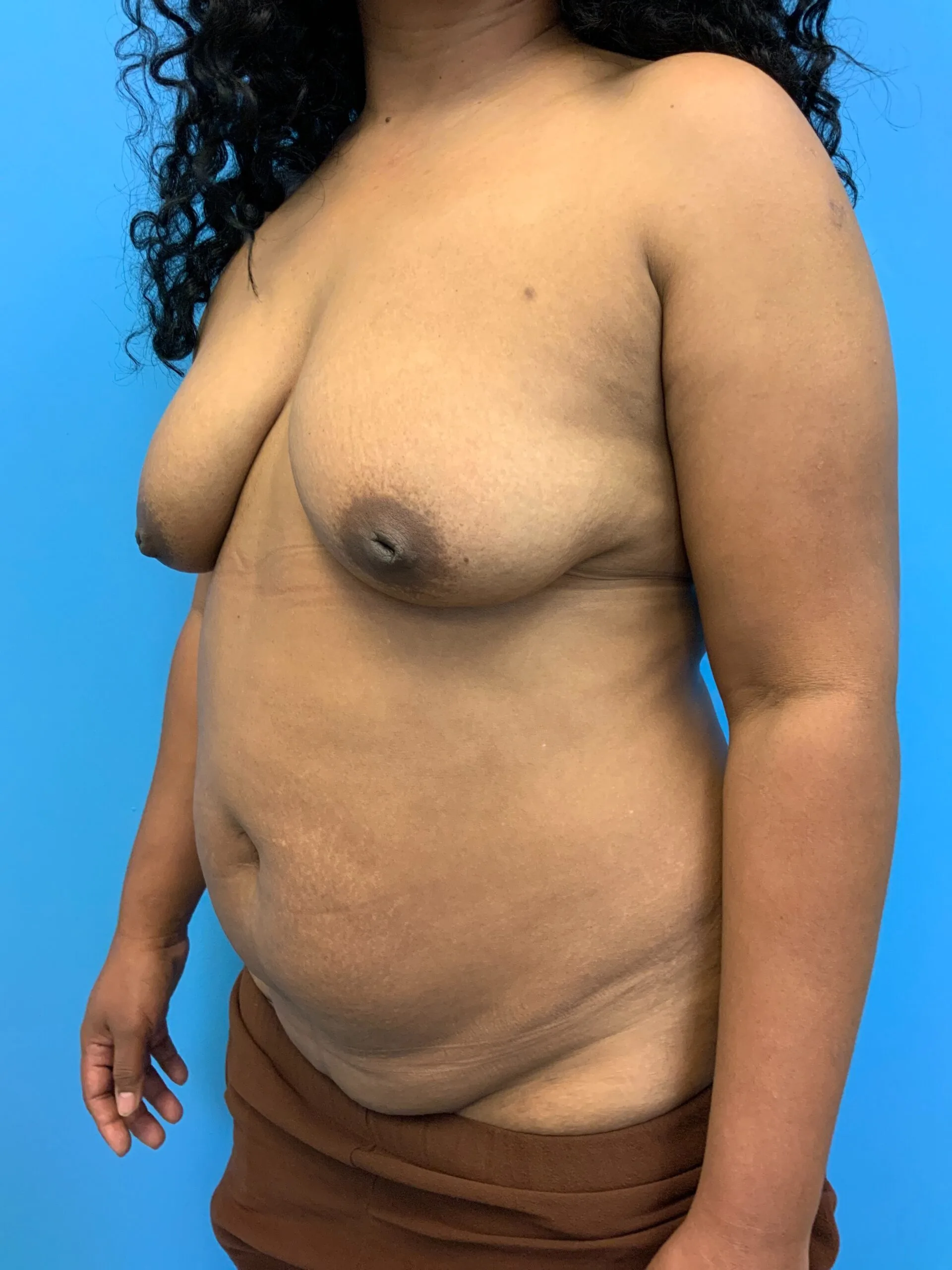 Abdominoplasty-Case--1110 | Before Tummy Tuck 5