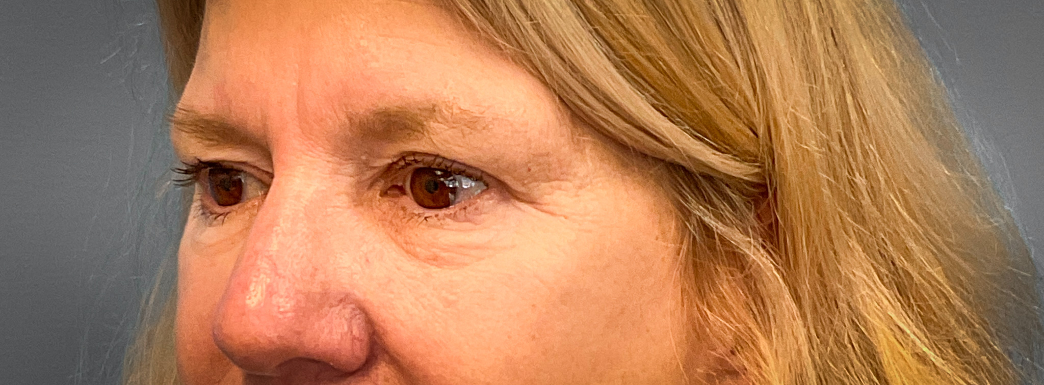 Blepharoplasty-Case--2653 | Before Dr. Frank Albino 2