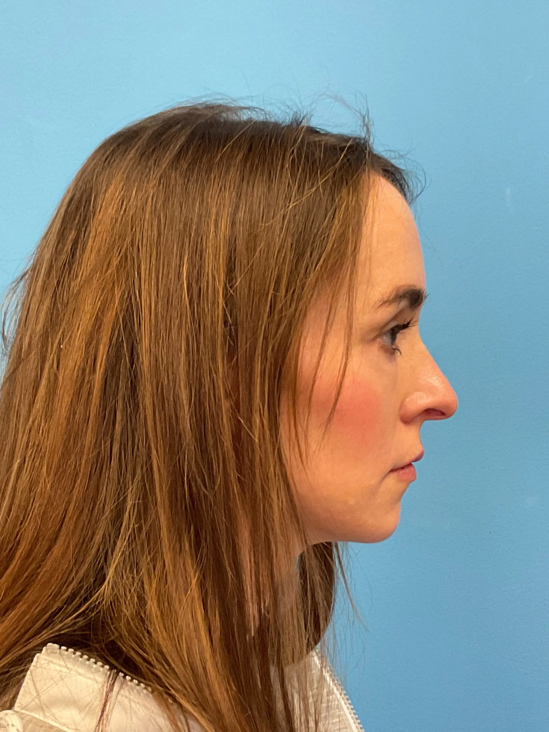 Rhinoplasty-Case--1281 | Before Rhinoplasty 4