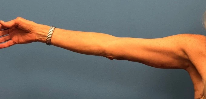 After photo of patient undergoing an arm lift