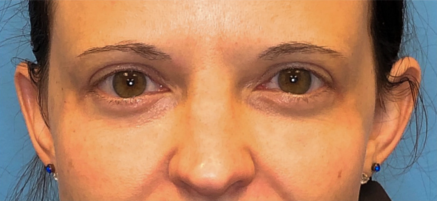 Upper-Blepharoplasty-Case--14261 | After Eyelid Surgery 1