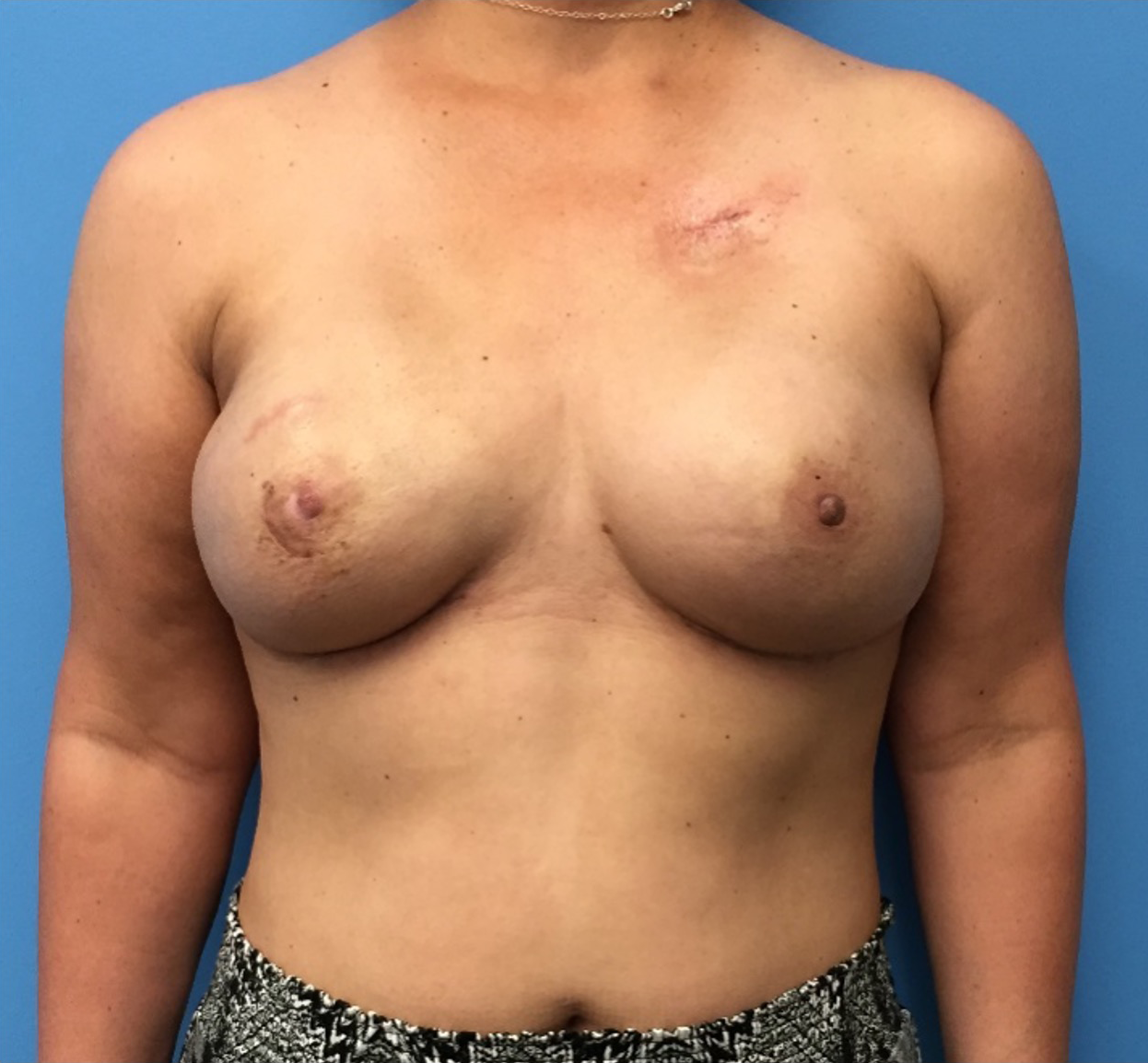 Breast-Reconstruction-Case--400 | After Breast Reconstruction 1