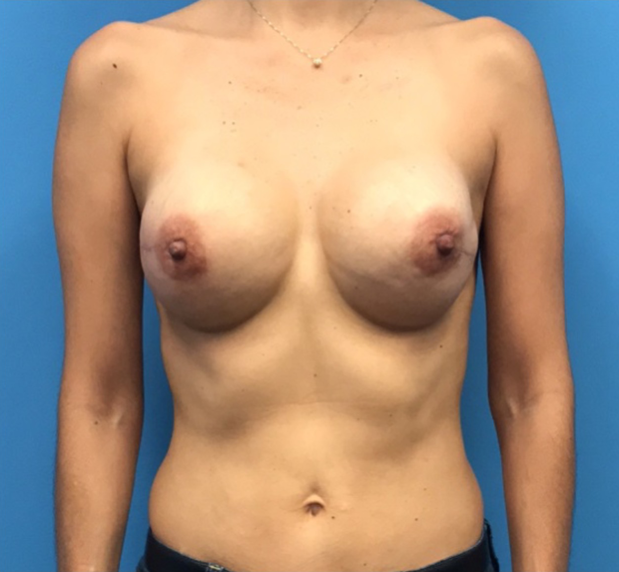 Breast-Reconstruction-Case--304 | After Breast Reconstruction 1