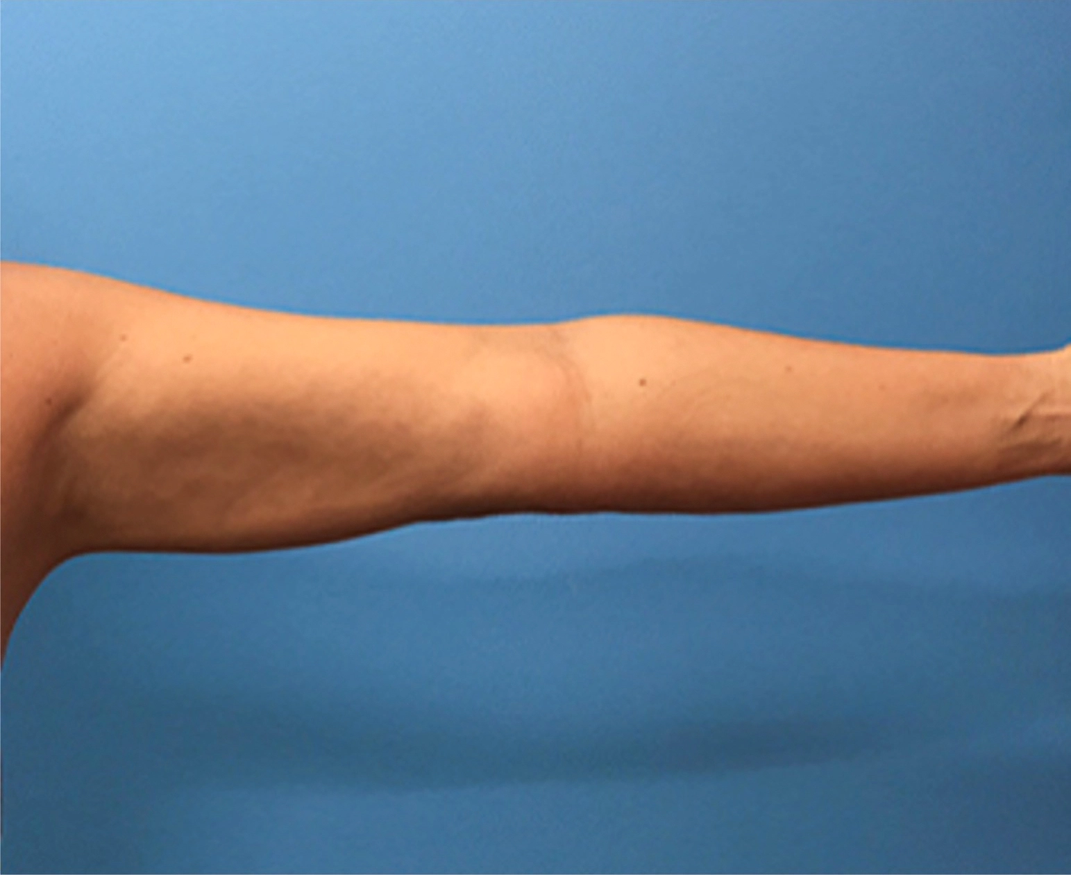 Liposuction-Case--72-2 | After Body 1