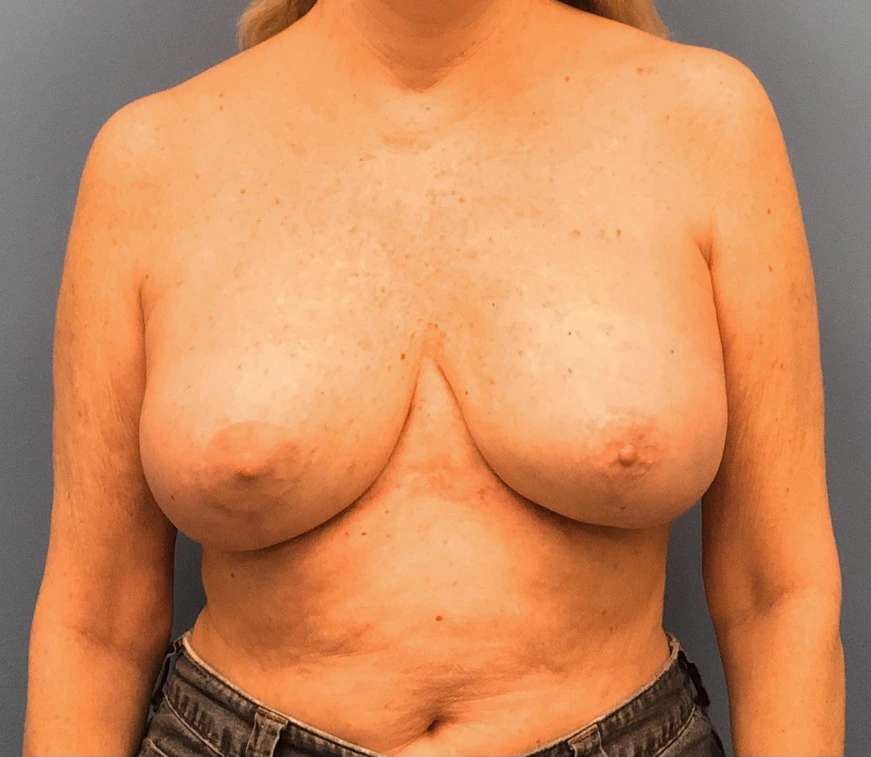 Case--9690 | After Breast Reconstruction 1