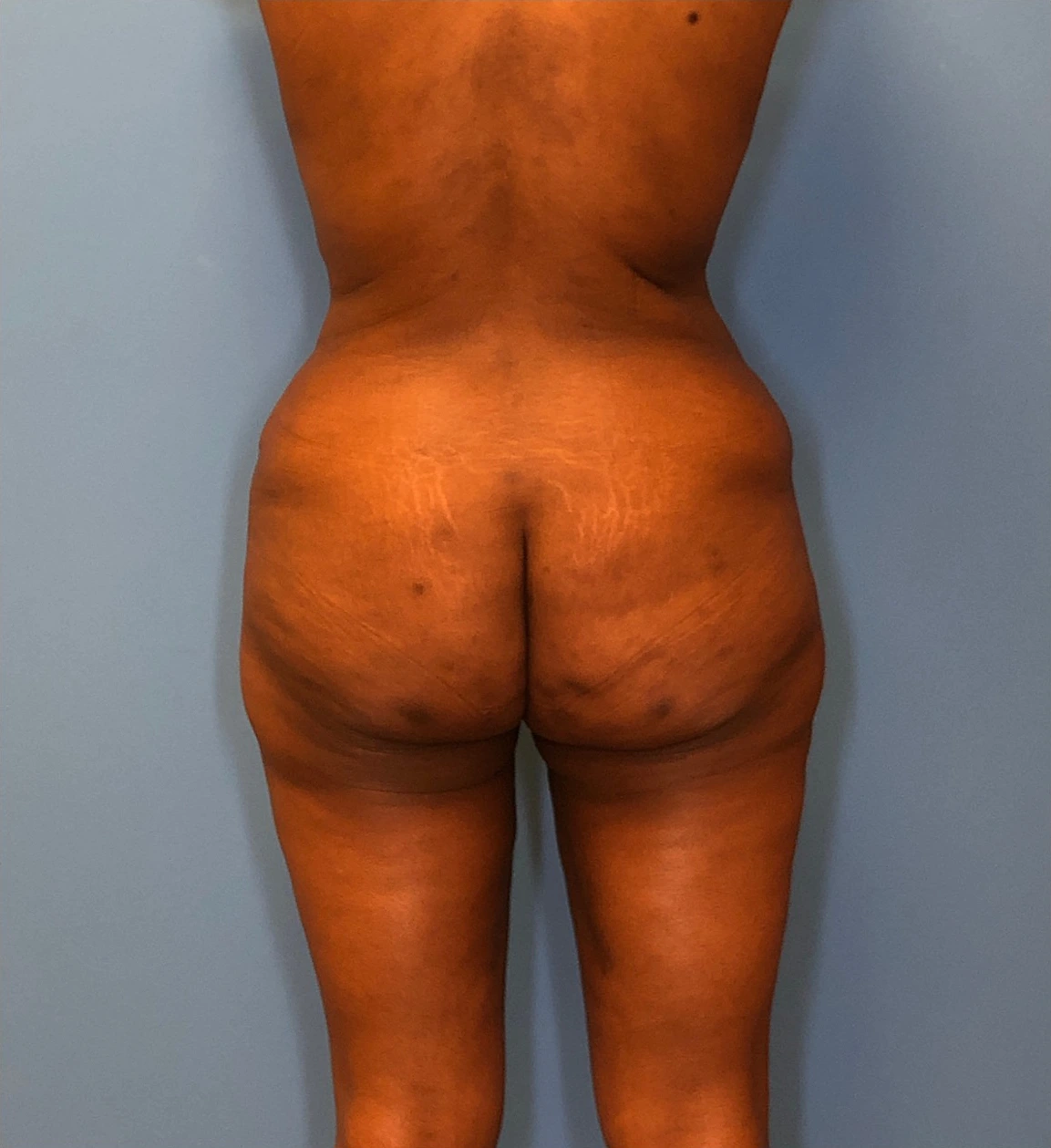 Mommy-Makeover-Case--13869 | After Mommy Makeover 4