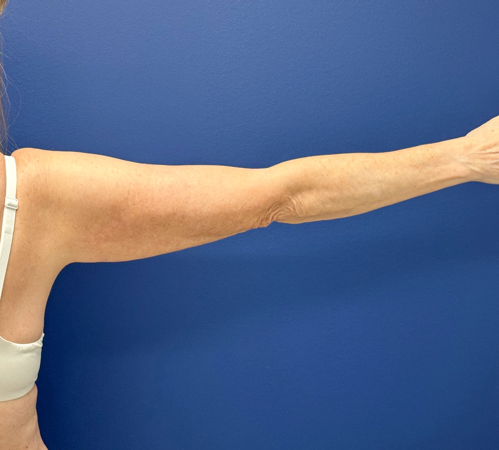 Liposuction-Case--23690-2 | After Liposuction 3