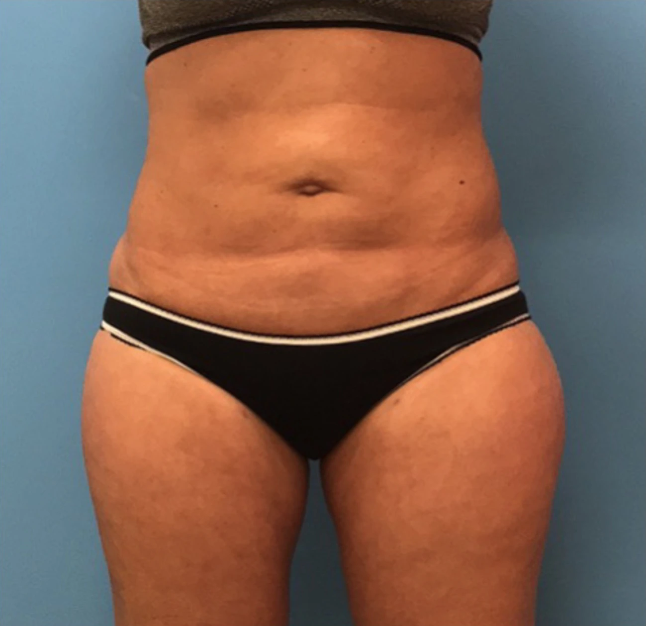 Liposuction-Case--72-1 | After Body 1