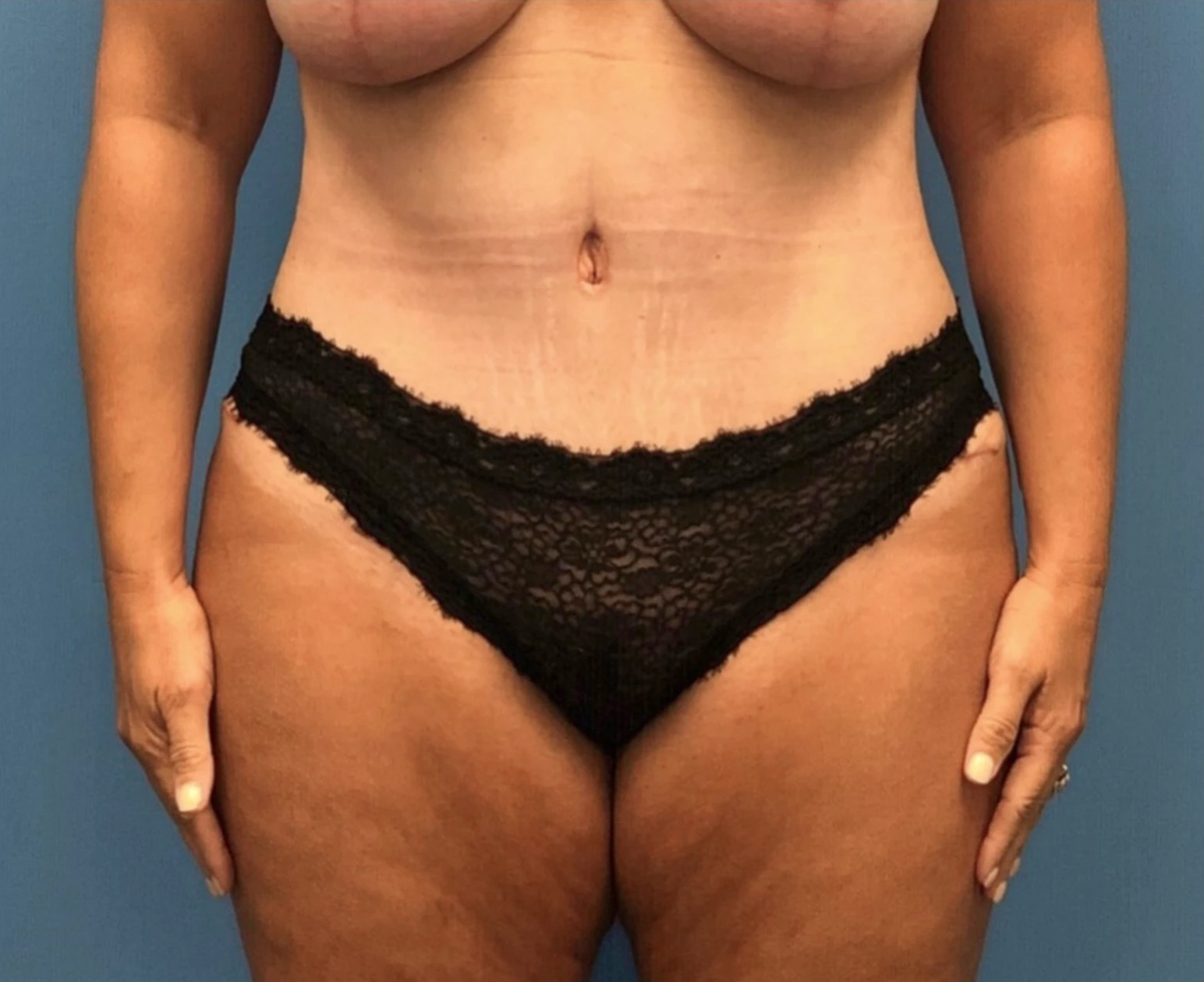 Case--252 | After Body 1