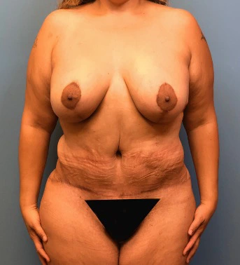 Lipoabdominoplasty-Breast-Augmentation-Case--15133 | After Mommy Makeover 1