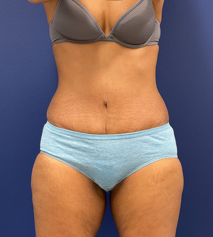 Abdominoplasty-Case--24922 | After Body 1
