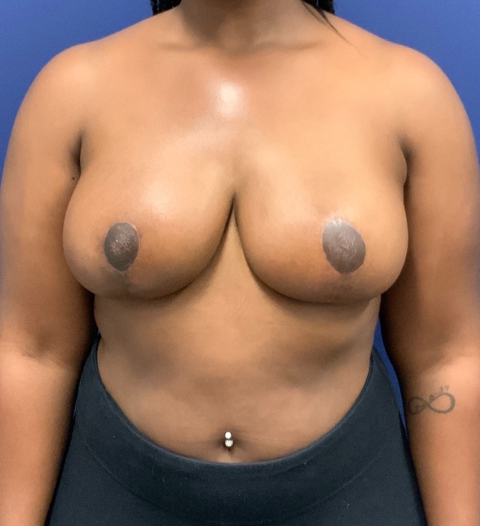 Breast-Reduction-Case--27530 | After Dr. Arjun Kanuri 1