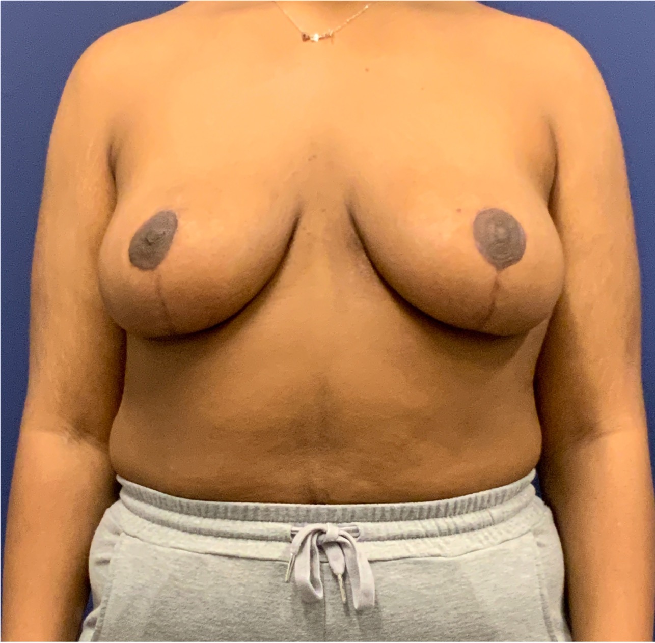Breast-Reduction-Case--27281 | After Dr. Arjun Kanuri 1
