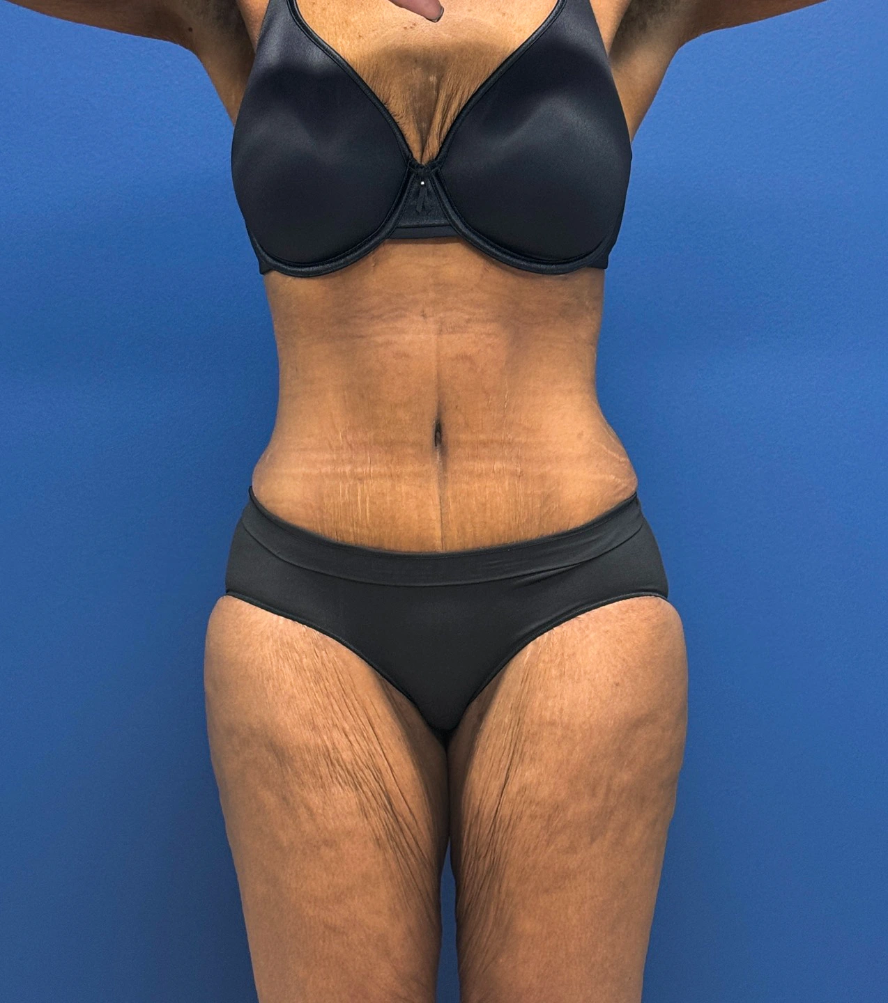 Tummy-Tuck-Case--28714 | After Tummy Tuck 1