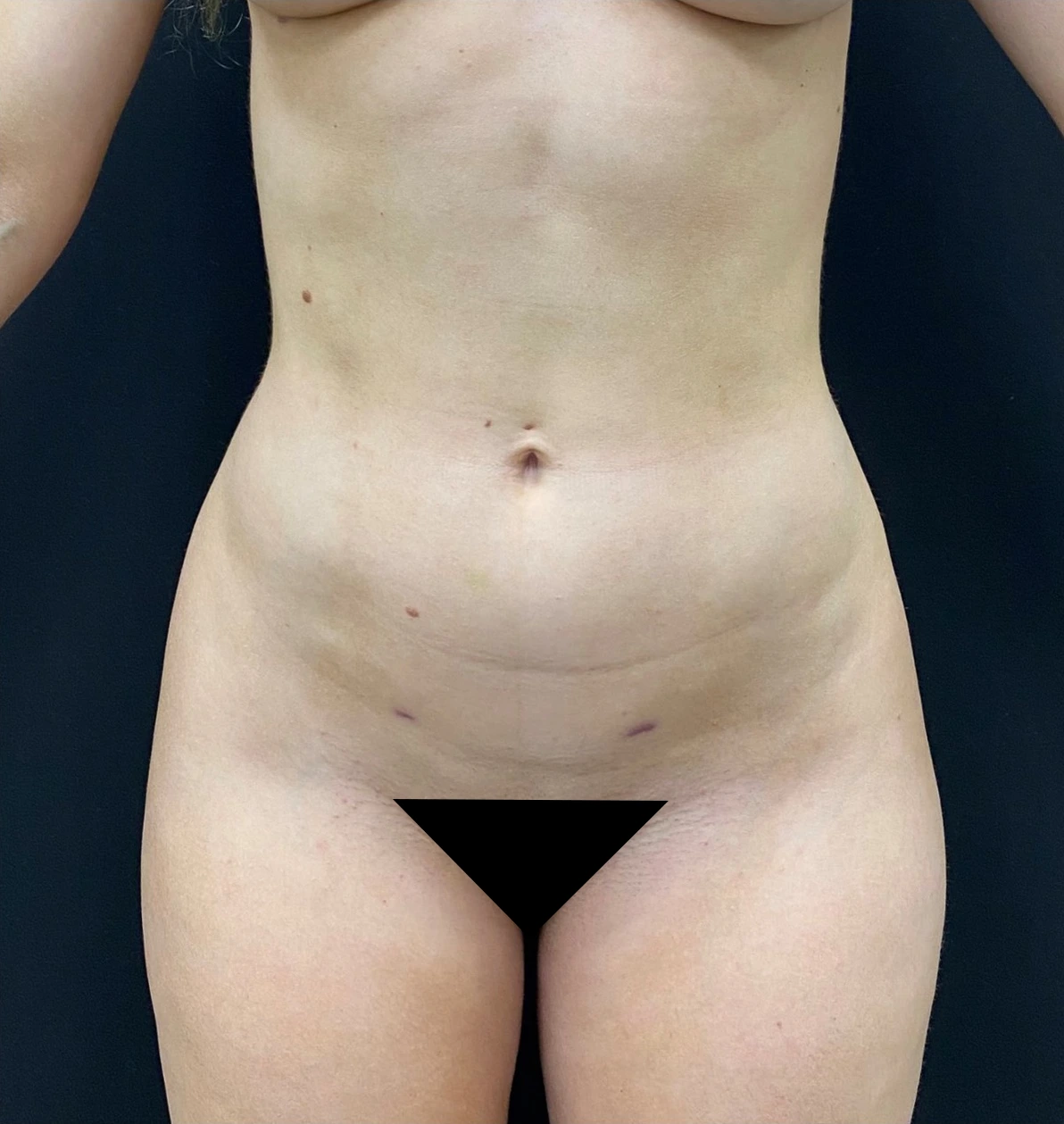 Brazilian-Butt-Lift-Case--366 | After Brazilian Butt Lift 1
