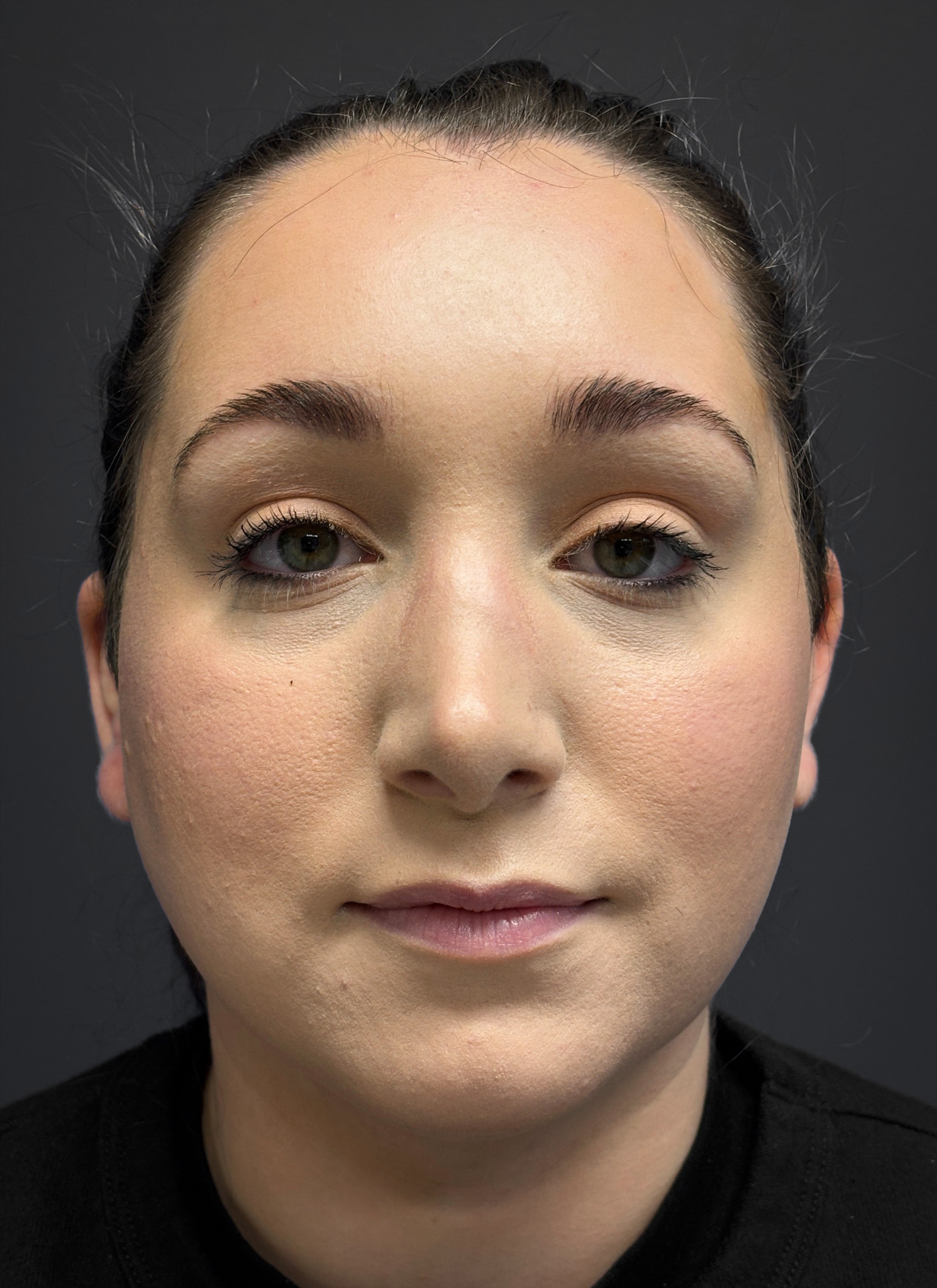 Submental-Liposuction-Case--3439 | After Submental Liposuction 1