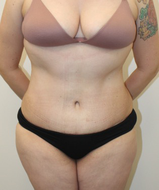 Liposuction-Tummy-Tuck-Case--343 | After Body 1